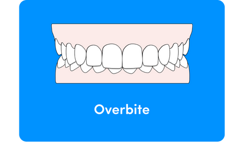 Can aligners fix an overbite?