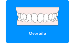 Can aligners fix an overbite?