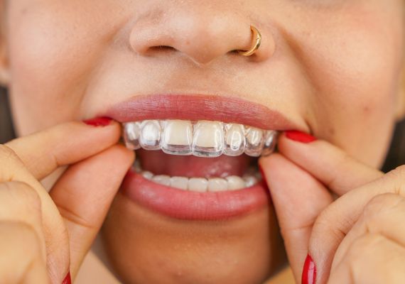  A woman putting on removable braces 