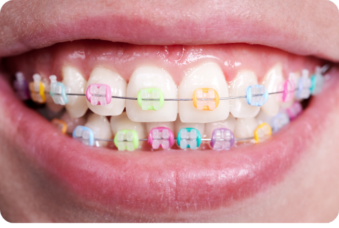 The most popular braces colours in the UK (2025 trends)