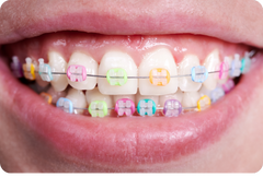 The most popular braces colours in the UK (2026 trends)