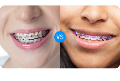 Silver vs. purple braces: What color suits your skin tone?