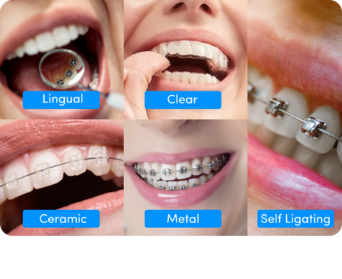 Different types of braces & which one is right for you?