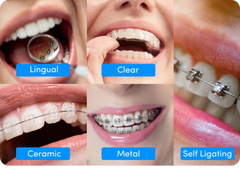 Different types of braces & which one is right for you?
