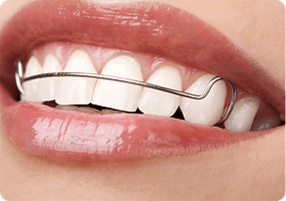 The Complete Guide to Retainers for Teeth in the UK