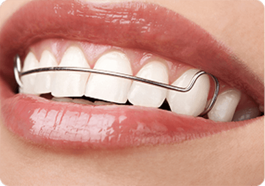 The Complete Guide to Retainers for Teeth in the UK