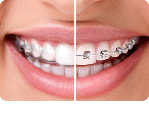 Train track braces vs. clear aligners: Which is more effective?