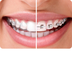 Train track braces vs. clear aligners: Which is more effective?