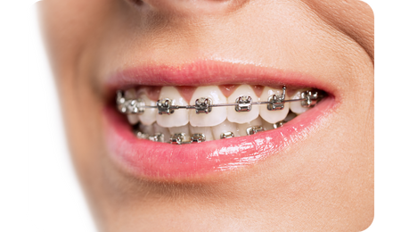 How long do braces take to work?