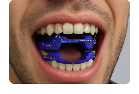 Block braces: Pros, cons & what to expect