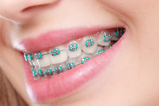 A girl wearing fashion braces