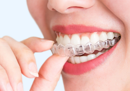  A close-up of a girl applying clear aligners.