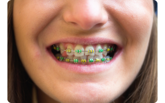 What are the most popular braces colors?