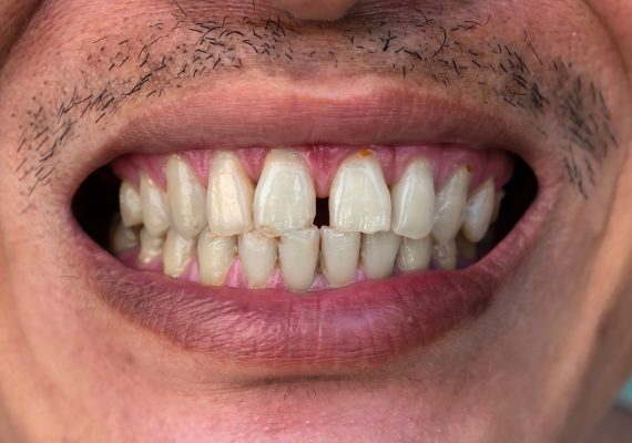  A man with a minor tooth gap.