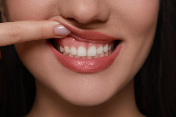 A young woman with healthy gums during aligner treatment