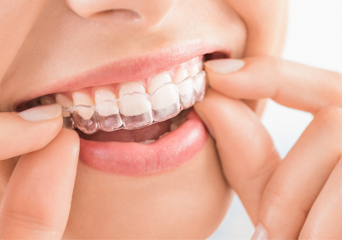  A woman wearing aligners