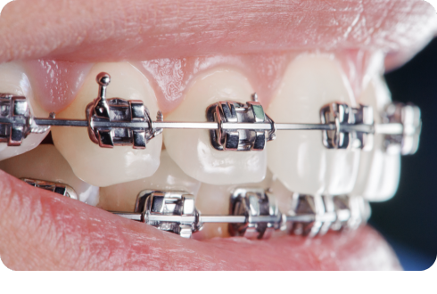 How to reduce pain from braces in the first week