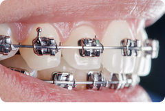 How to reduce pain from braces in the first week