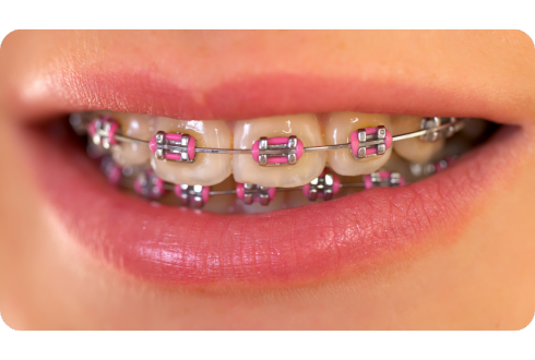 What braces colors should you avoid?
