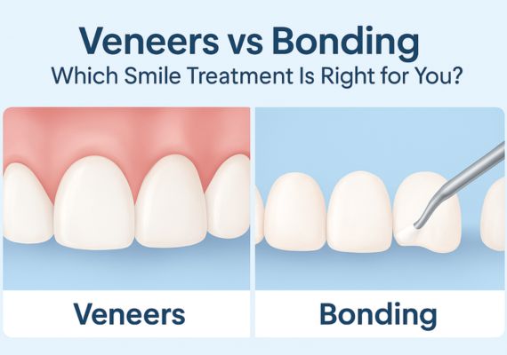 An image shows an illustration of veneers on one side and teeth bonding on the other side.