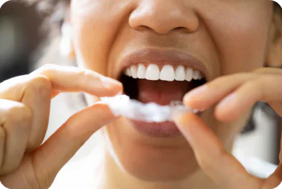 Can a mouth guard fix your bruxism permanently?