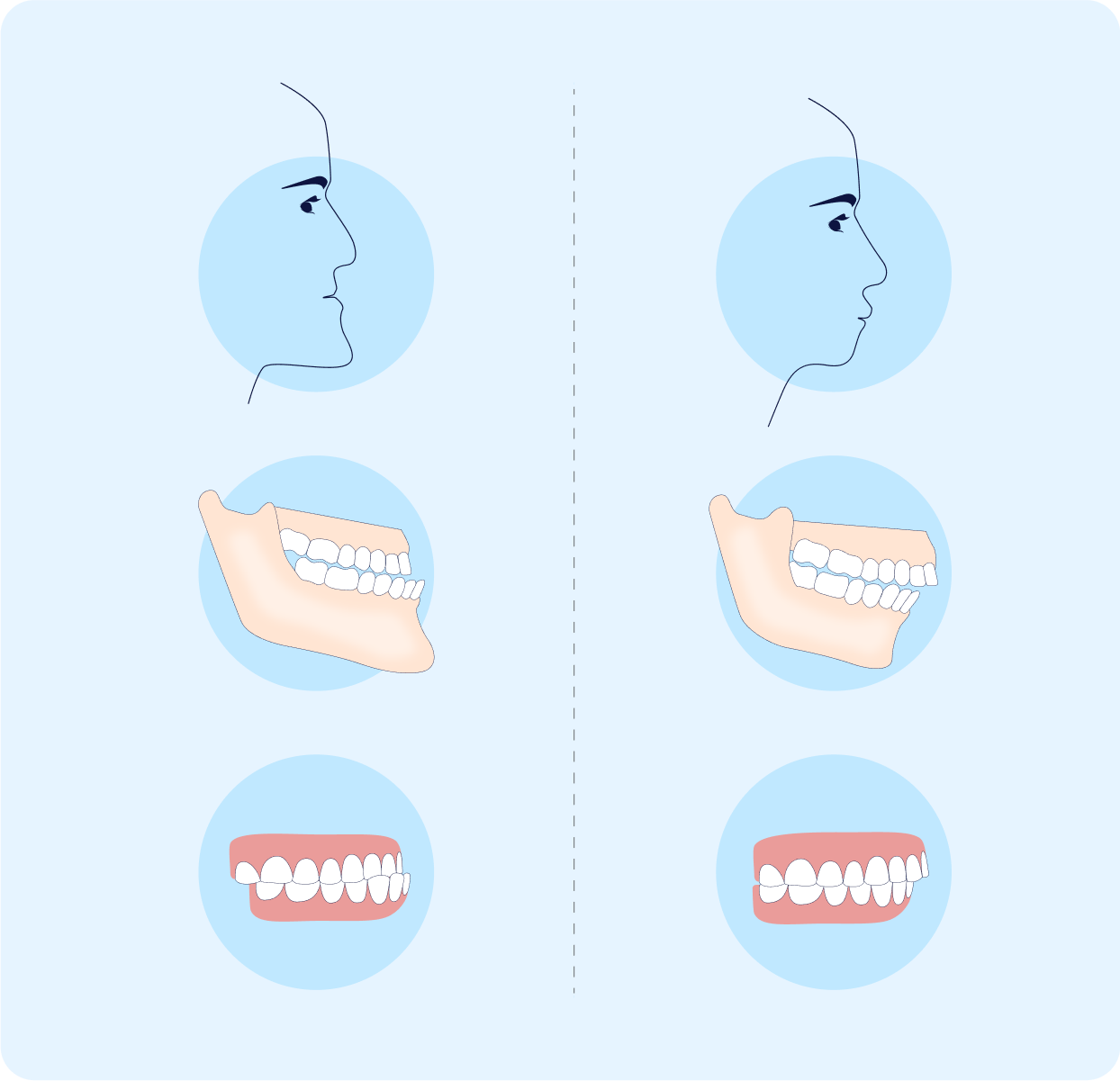 What an underbite and an overbite look like