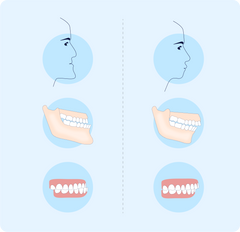Underbite vs overbite: Health implications and the best treatment options