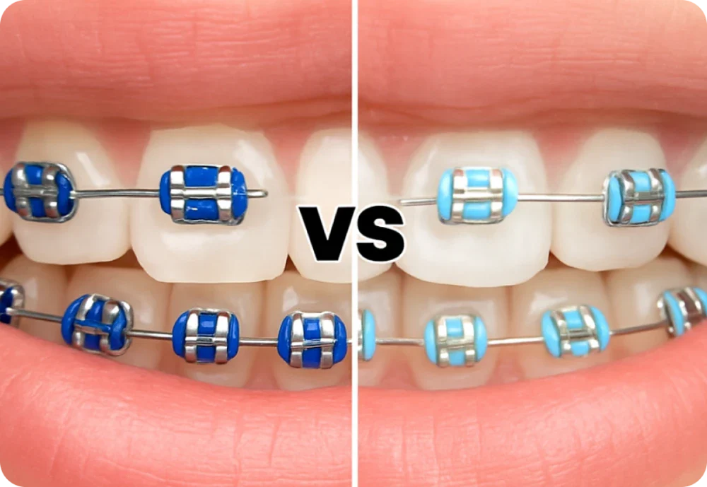 Light blue vs. dark blue braces: What’s best for you?