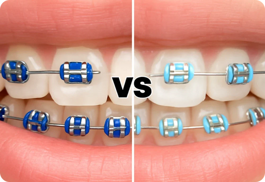 Light blue vs. dark blue braces: What’s best for you?