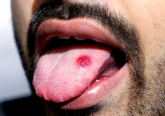 A man with a wart on his tongue
