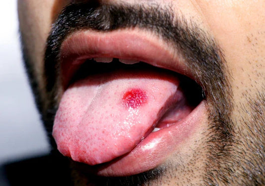 A man with a wart on his tongue