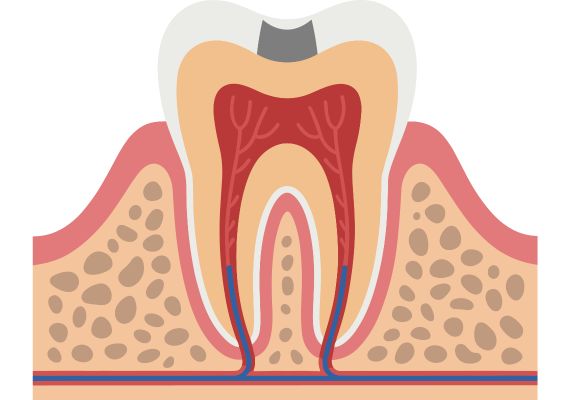  A diagram showing a tooth after pulpotomy and dental filling