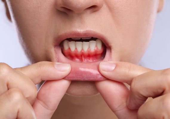 A woman showing signs of early gingivitis.