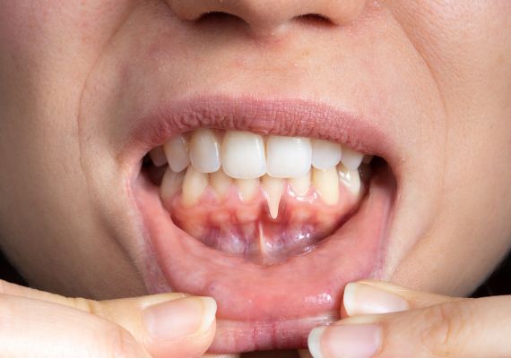 A woman with receding gums