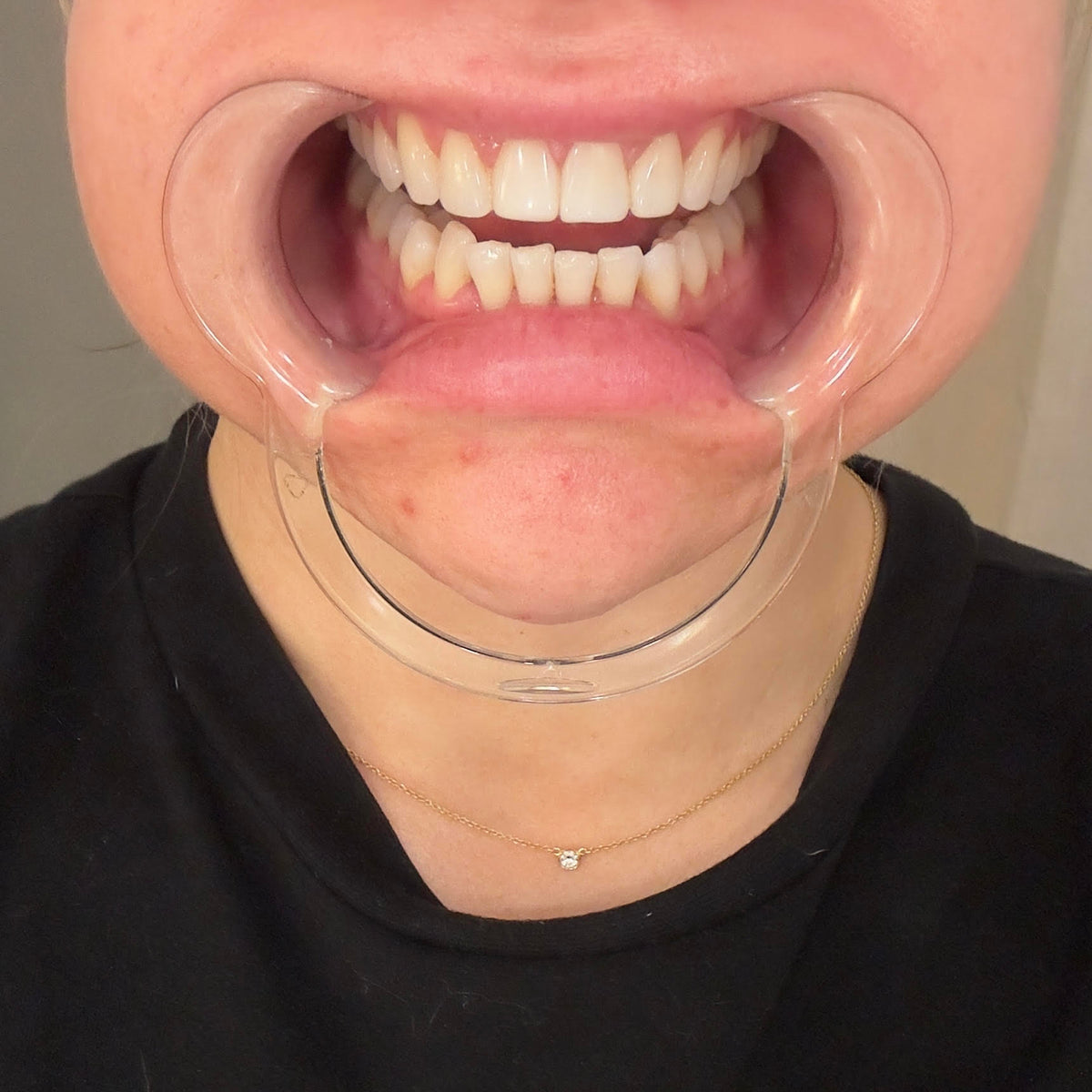 Before treatment