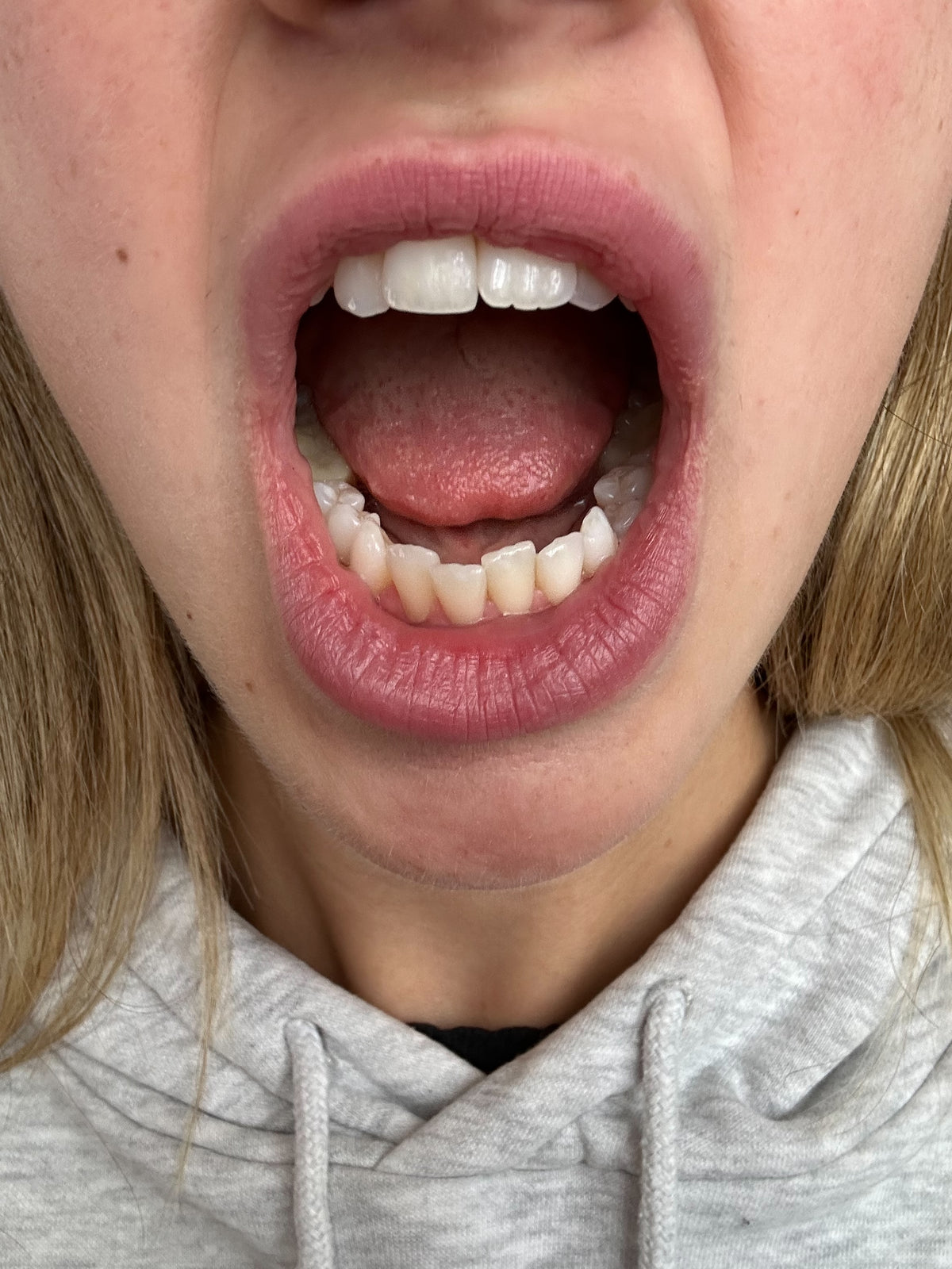 After treatment