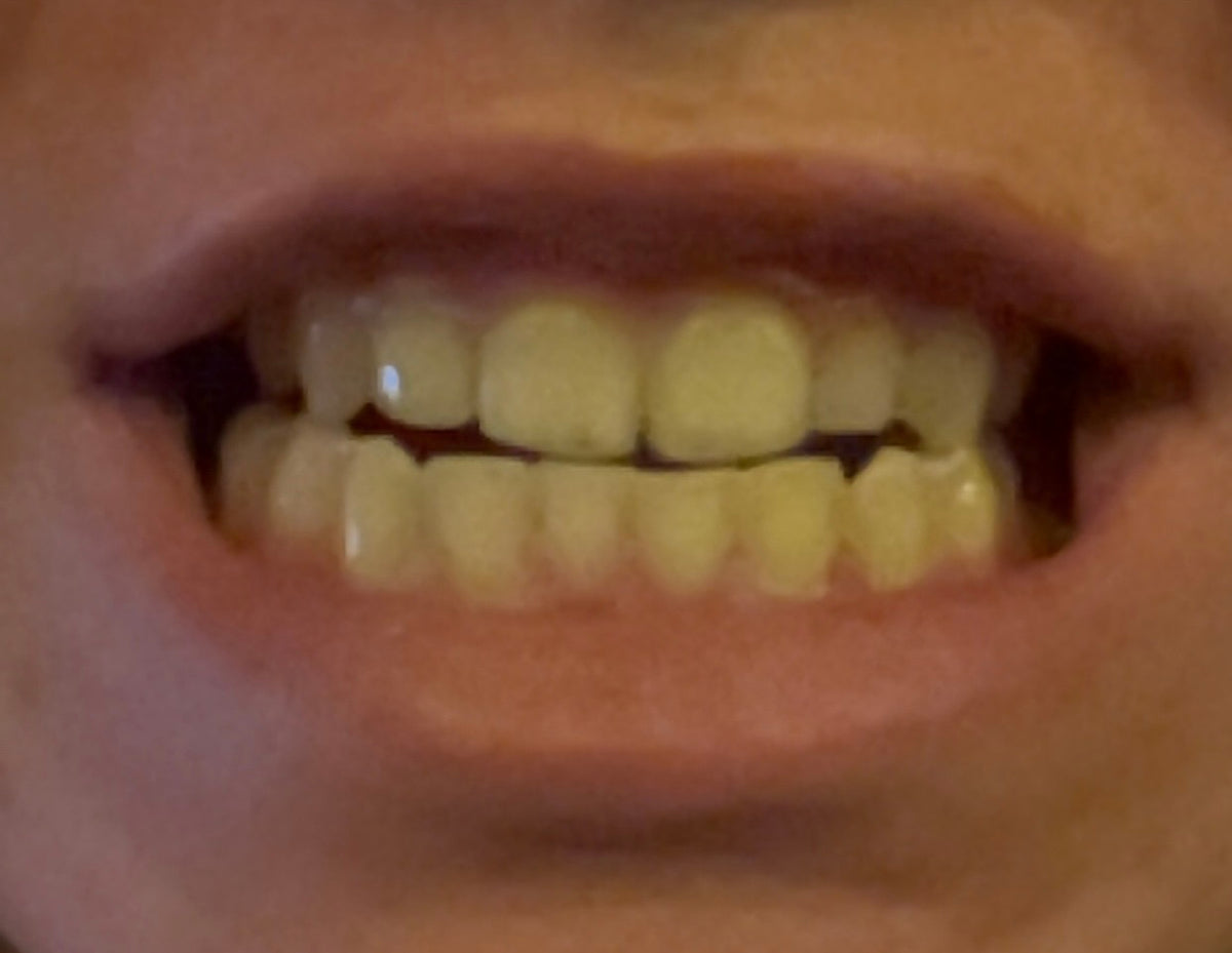 Before treatment