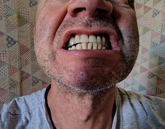 Before treatment