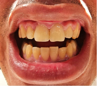 Before treatment
