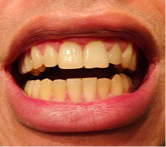 After treatment