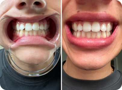 Caspersmile - Overlapping