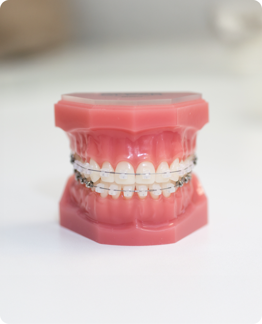 Ceramic braces