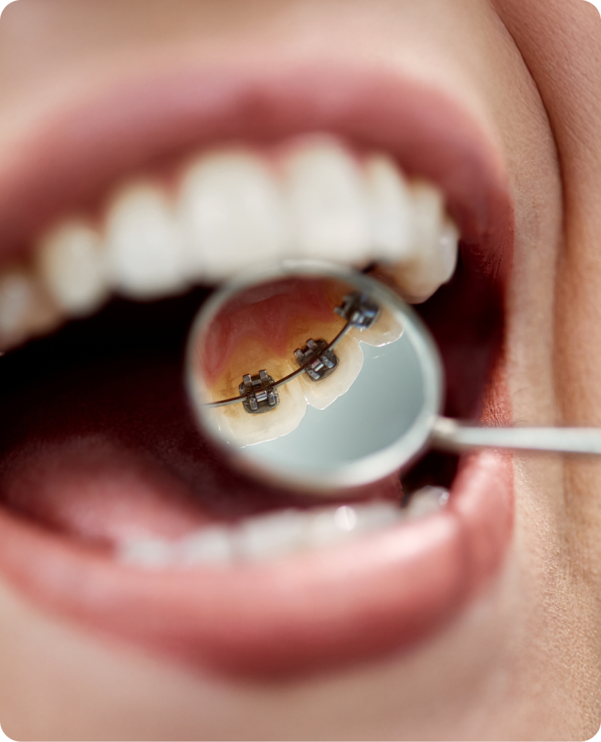 Lingual Braces
