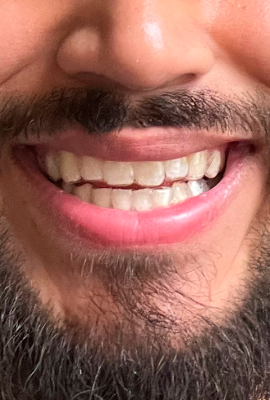 After treatment