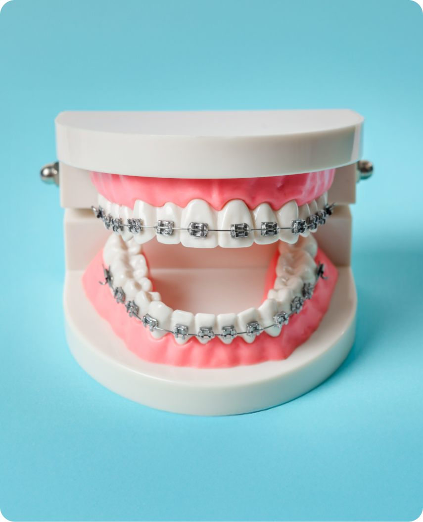 Metal braces