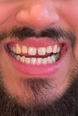 Before treatment