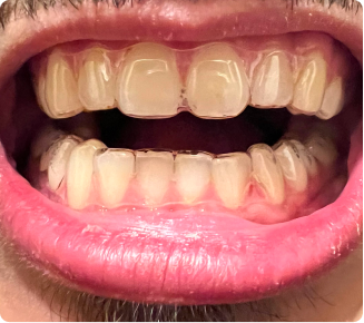I love my new smile!