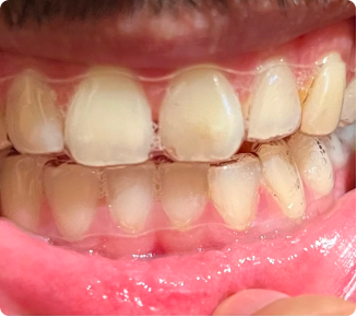 I love my new smile!