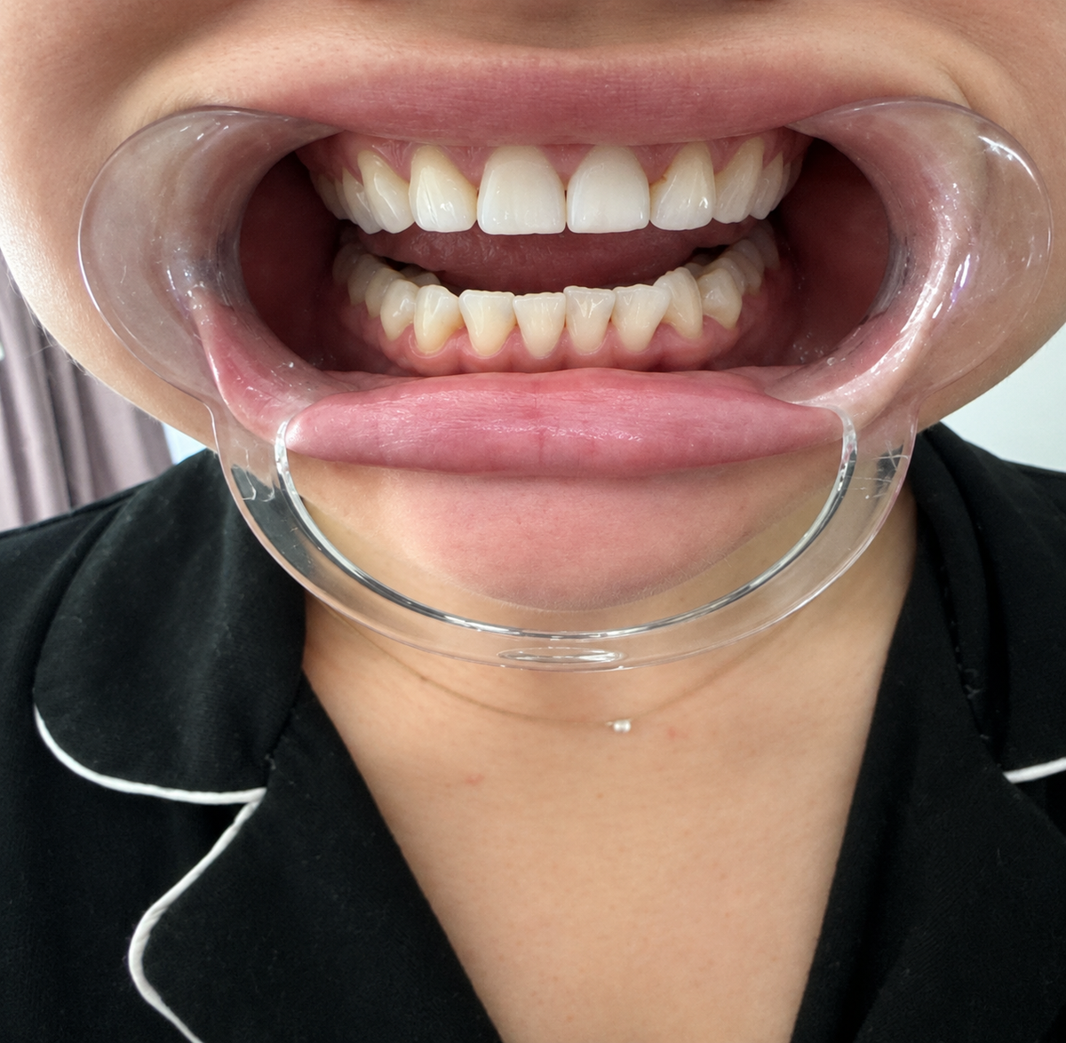 After treatment
