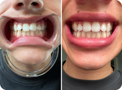 Caspersmile - Overlapping